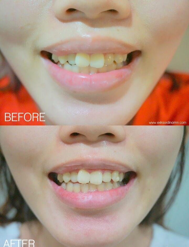 Amazing DIY Teeth Whitening Remedies