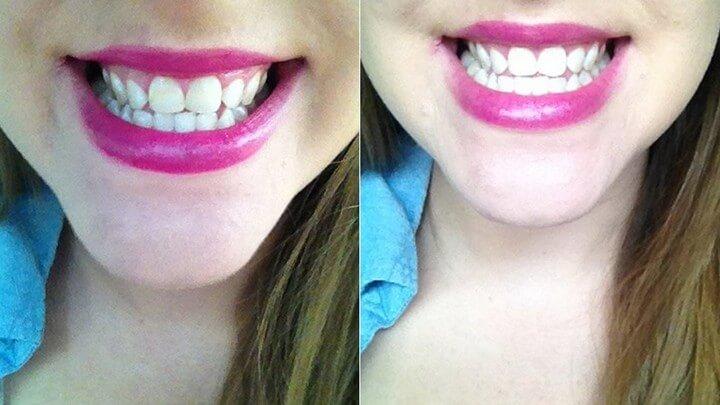 DIY Best Way To Teeth White