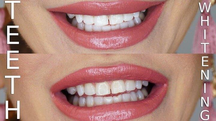 DIY Teeth Whitening Using Charcoal Baking Soda