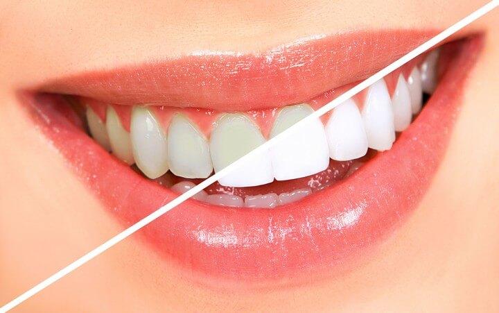 DIY Teeth Whitening in Hyderabad