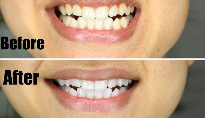 How To Teeth White In Just 5 Minutes