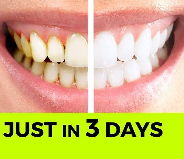 Instant Teeth Whitening Diy Without Baking Soda